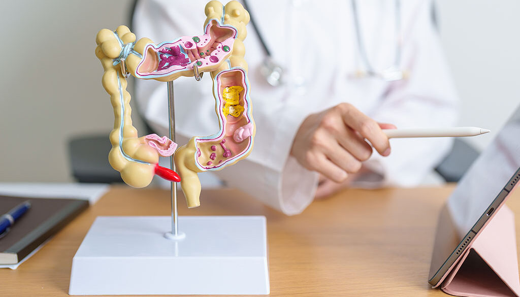 Closeup Of An Anatomical Model Of A Colon On A Desk With A Gastroenterologist Pointing At A Tablet Can Ulcerative Colitis Be Cured