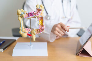 Closeup Of An Anatomical Model Of A Colon On A Desk With A Gastroenterologist Pointing At A Tablet Can Ulcerative Colitis Be Cured